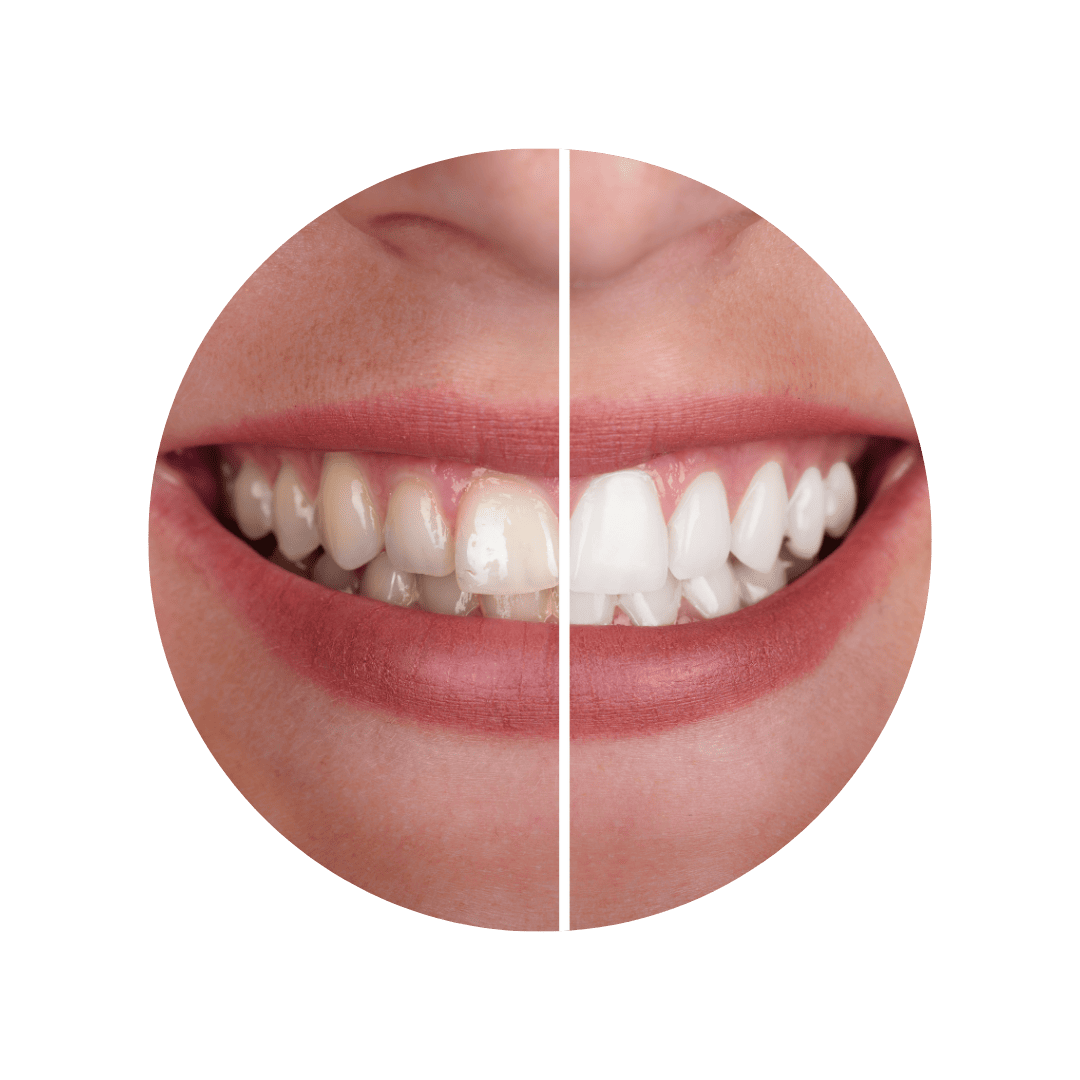 CLAREAMENTO DENTAL