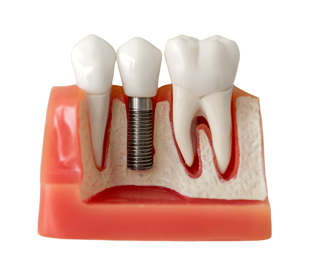 Implantes